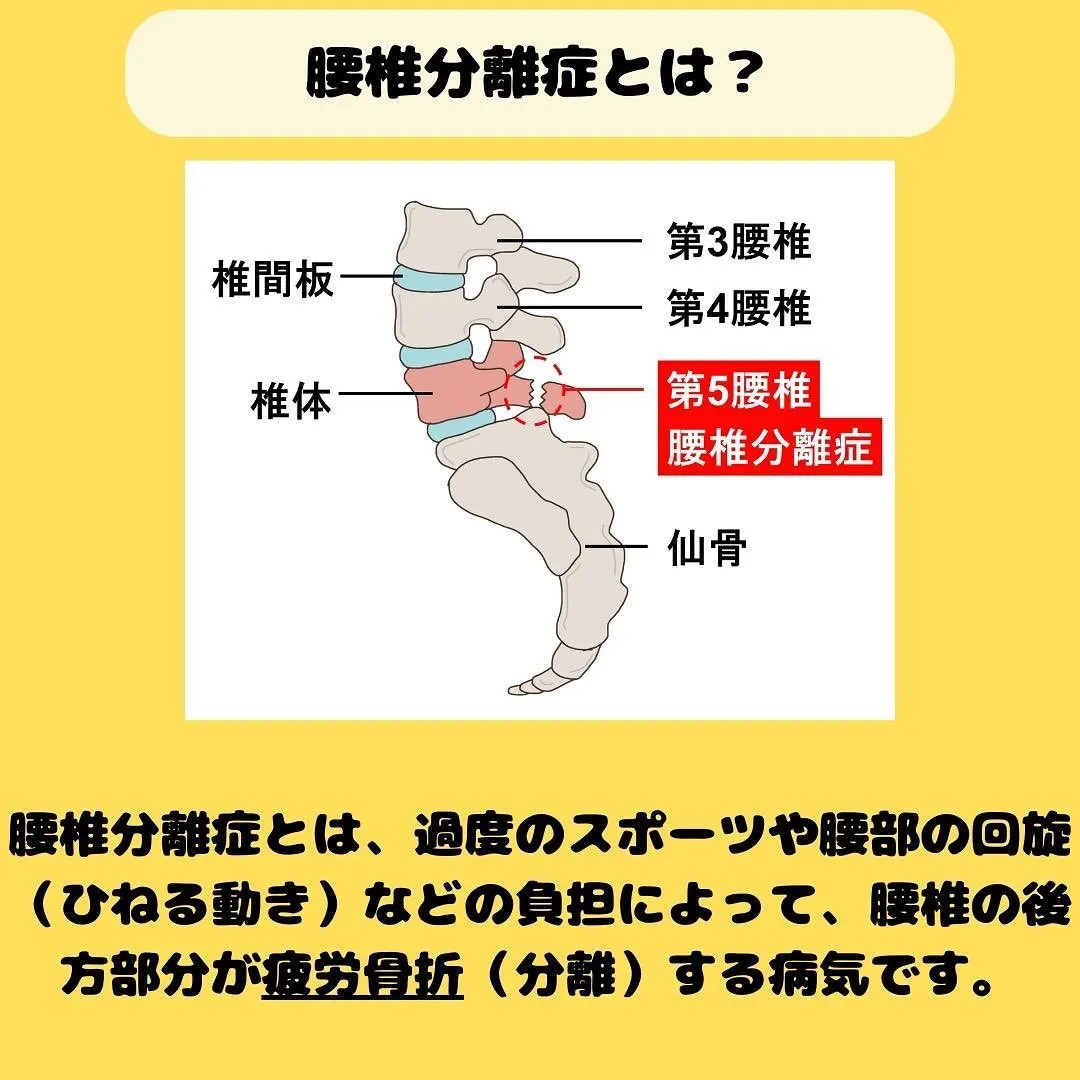 福岡市腰椎分離症