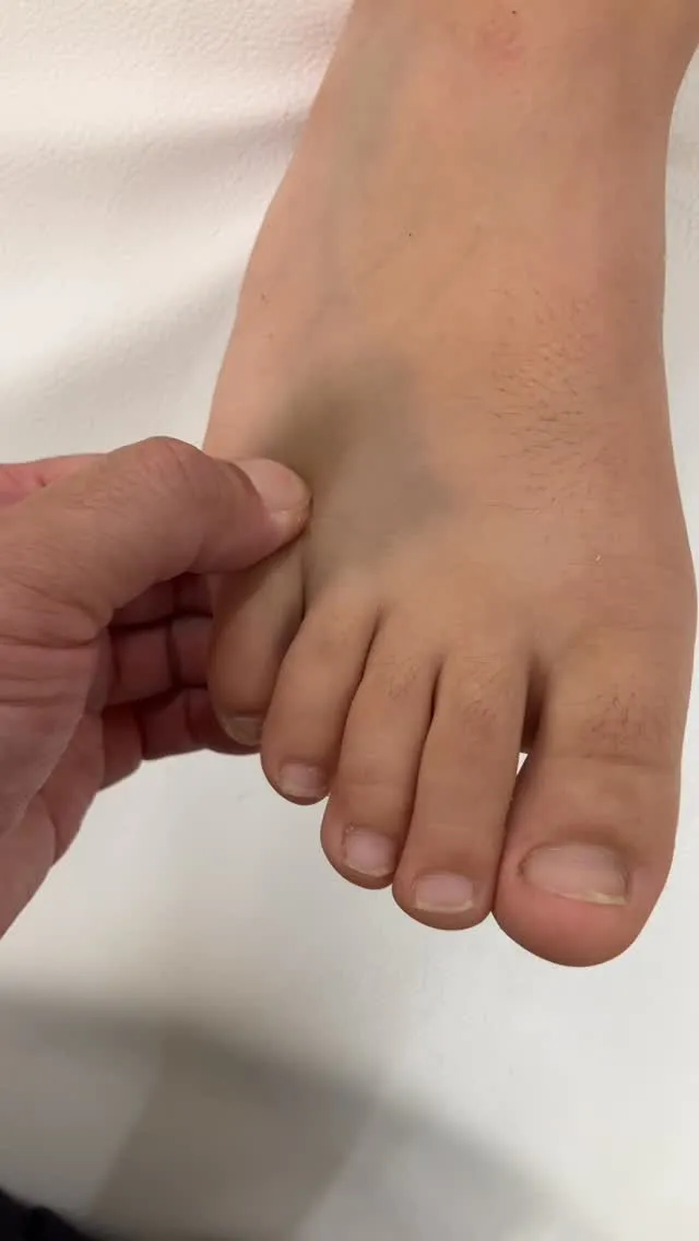 小学生男子　足趾不全骨折