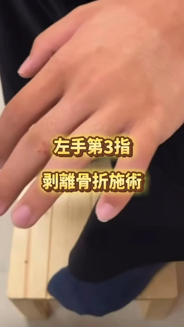 【左手第3指剥離骨折の施術】